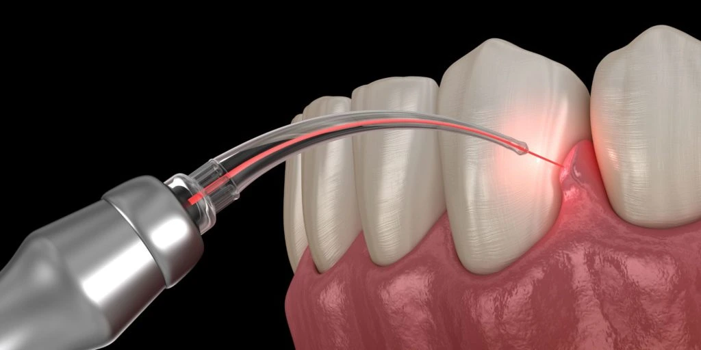 Periodontics or Gum Disease