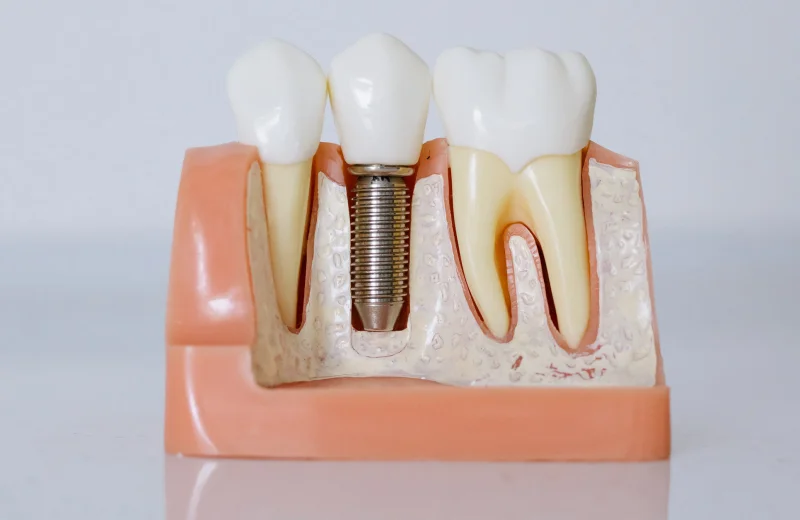 Implants Surgery